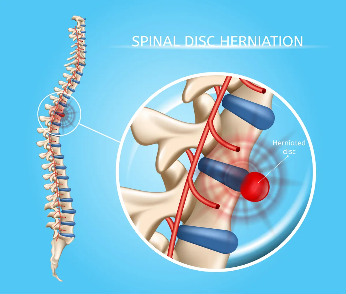 How Chiropractic Care May Help Treat Disc Injuries Without Surgery