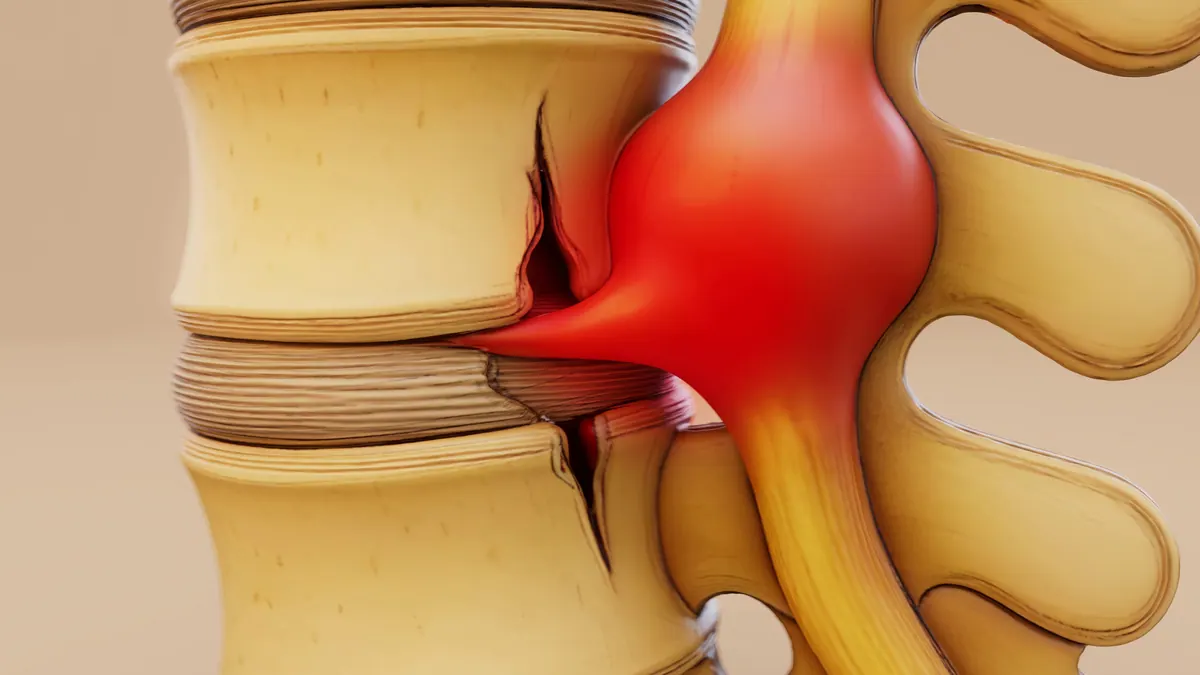 Degenerative Disc Disease: Managing and Preventing Disc Injuries