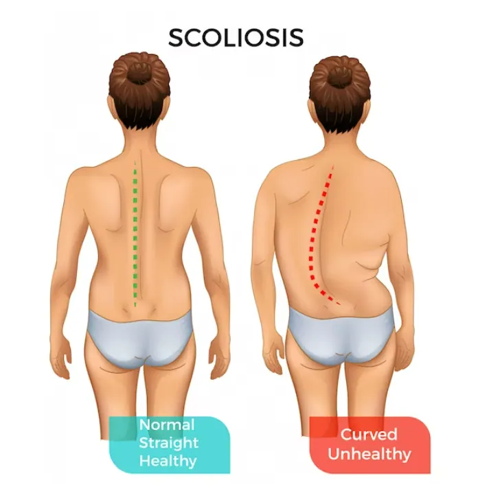 From Curved Spine to Better Posture: Chiropractic Care for Scoliosis