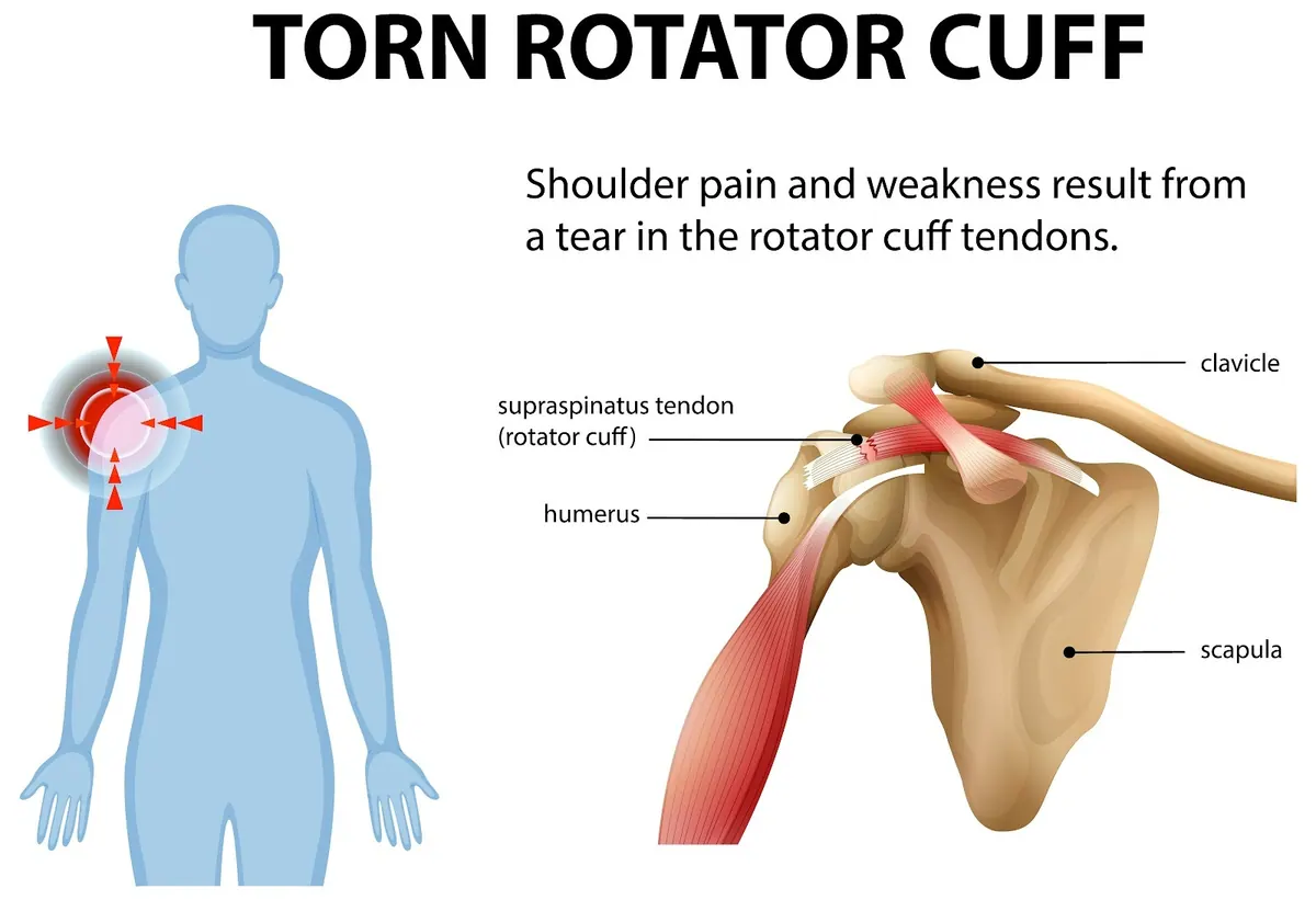 Shoulder Impingement Syndrome: Diagnosis and Treatment Options